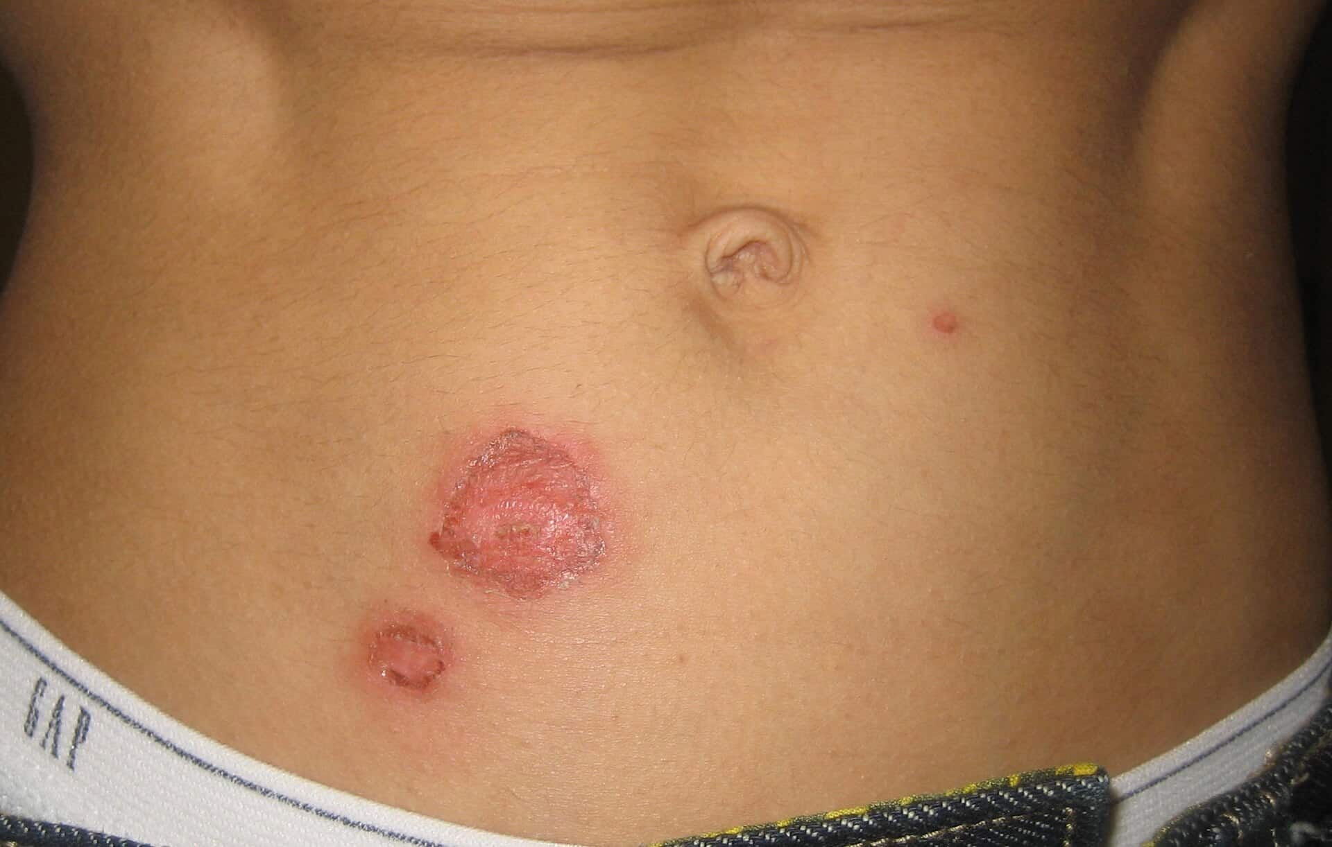 Huid van de onderbuik met twee ronde, rode plekken door krentenbaard (impetigo), met oppervlakkige erosie en korstvorming nabij de navel.