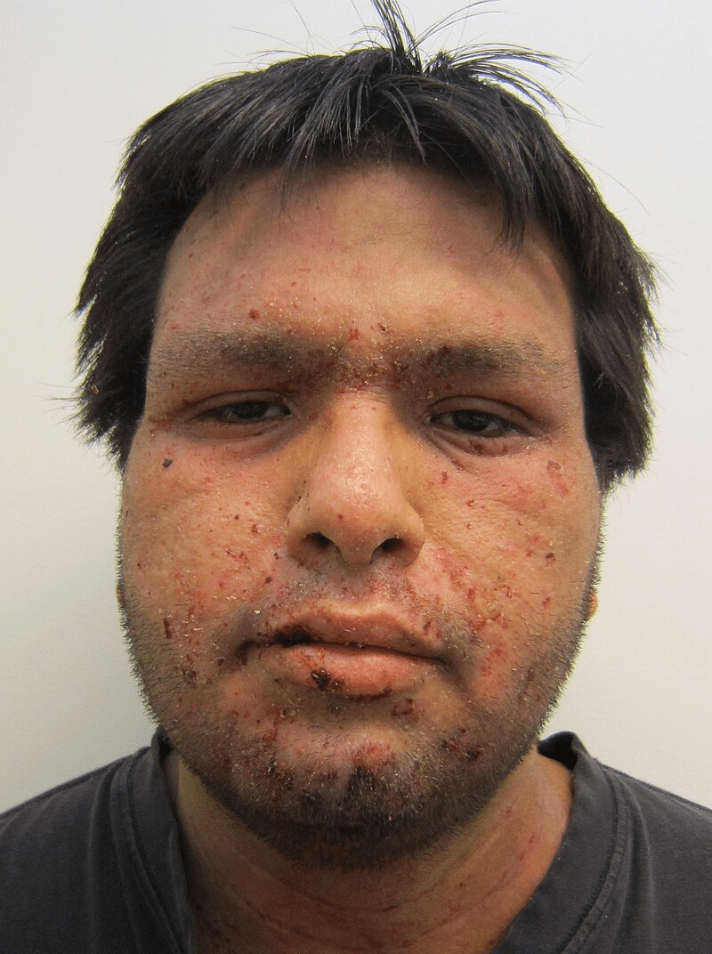 Gezicht van een volwassen man met uitgebreide huidinfectie door krentenbaard (impetigo), zichtbaar als korstvorming, roodheid en wondjes rond neus, lippen en wangen.