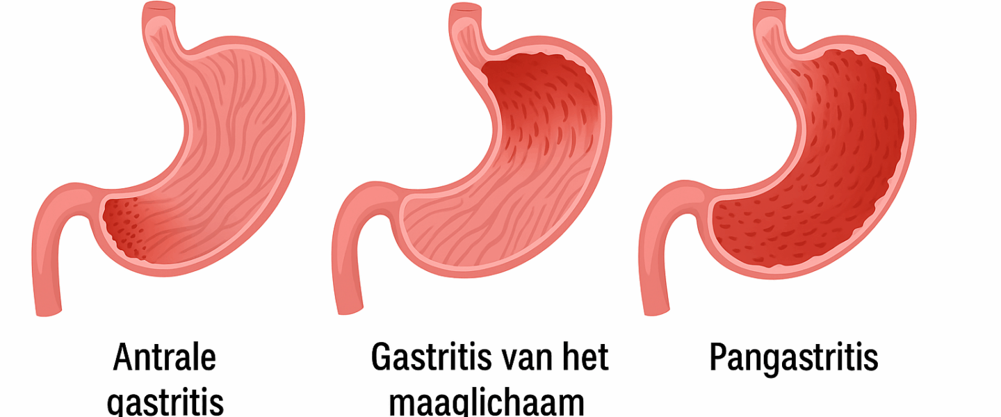 Medische illustratie van drie vormen van gastritis: antrale gastritis (onder in de maag), gastritis van het maaglichaam en pangastritis waarbij het hele maagslijmvlies ontstoken is.