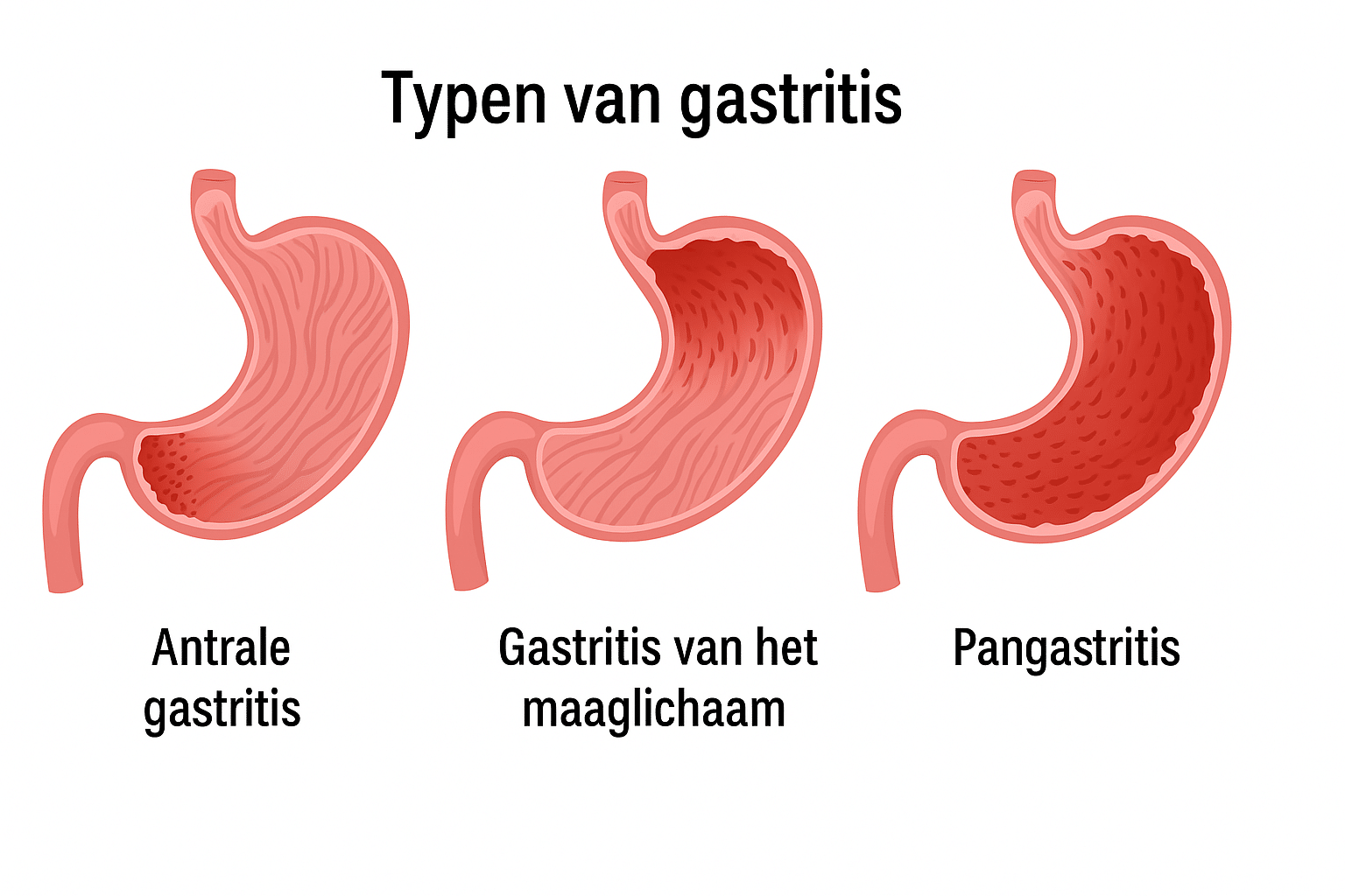 Medische illustratie van drie vormen van gastritis: antrale gastritis (onder in de maag), gastritis van het maaglichaam en pangastritis waarbij het hele maagslijmvlies ontstoken is.