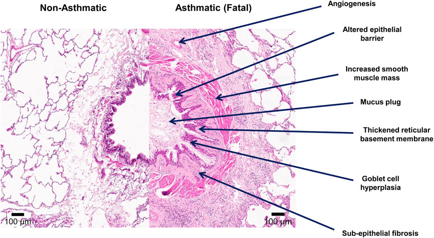 Histologische vergelijking tussen een gezonde bronchus en een astmatische bronchus, met zichtbaar dikkere spierlaag, slijmprop, fibrose en toename van gobletcellen bij astma.