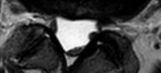 MRI-scan van de onderrug met adhesieve arachnoïditis, waarbij de theca-zak leeg oogt doordat de zenuwwortels aan de buitenwand vastgekleefd zijn.
