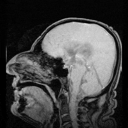 MRI-scan van het hoofd waarop de circulatie van hersenvocht zichtbaar is rond de hersenen en het ruggenmerg.