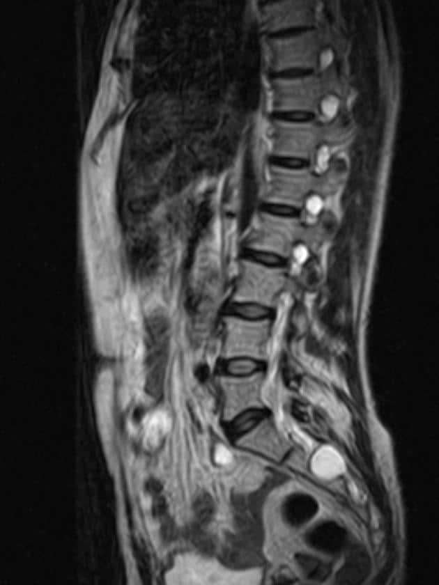 Sagittale MRI-scan van de wervelkolom waarop meerdere perineurale cysten zichtbaar zijn in het sacrale en dorsolumbale gebied, gelegen langs de zenuwwortels.