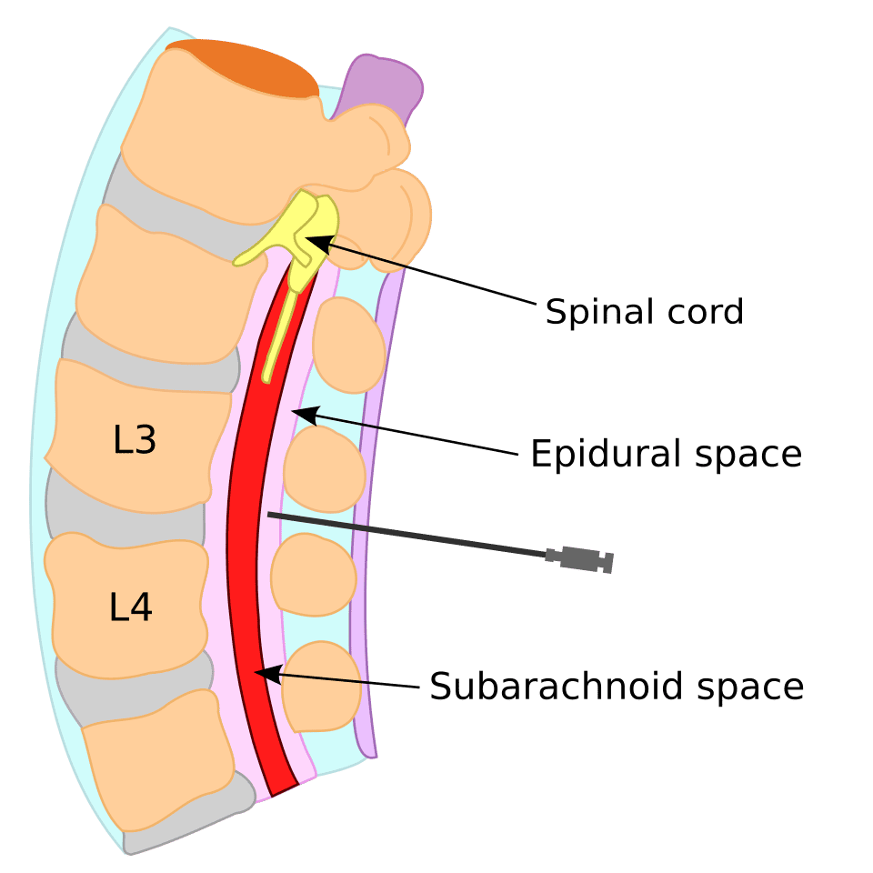 Schematische afbeelding van een epidurale blood patch in de onderrug, ter hoogte van L3 en L4, waarbij met een naald bloed in de epidurale ruimte wordt ingebracht om een liquorlek af te dichten.