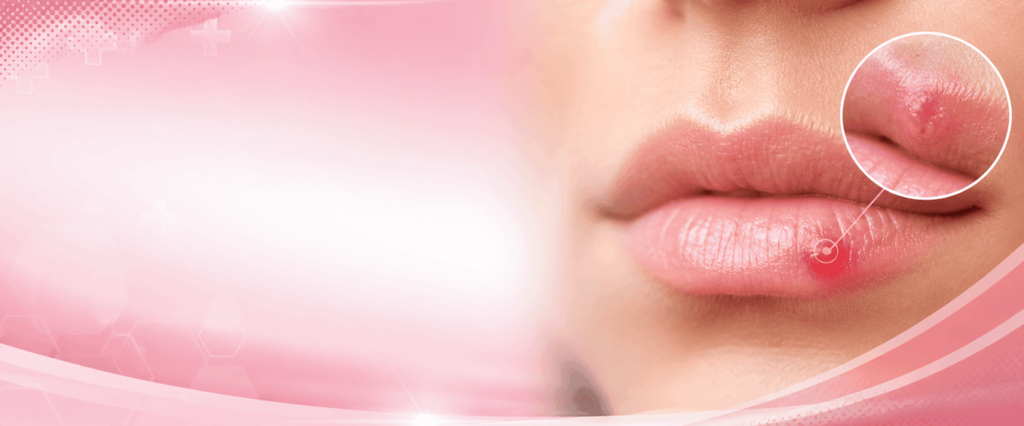 Close-up van een vrouwelijk gezicht met een klein rood bultje op de onderlip, weergegeven in een brede medische header met zachte roze tinten en subtiele visuele effecten.