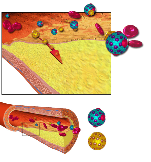 Medische illustratie van cholesteroldeeltjes en bloedcellen in een bloedvat, met een uitvergrote doorsnede van vetophoping in de vaatwand.
