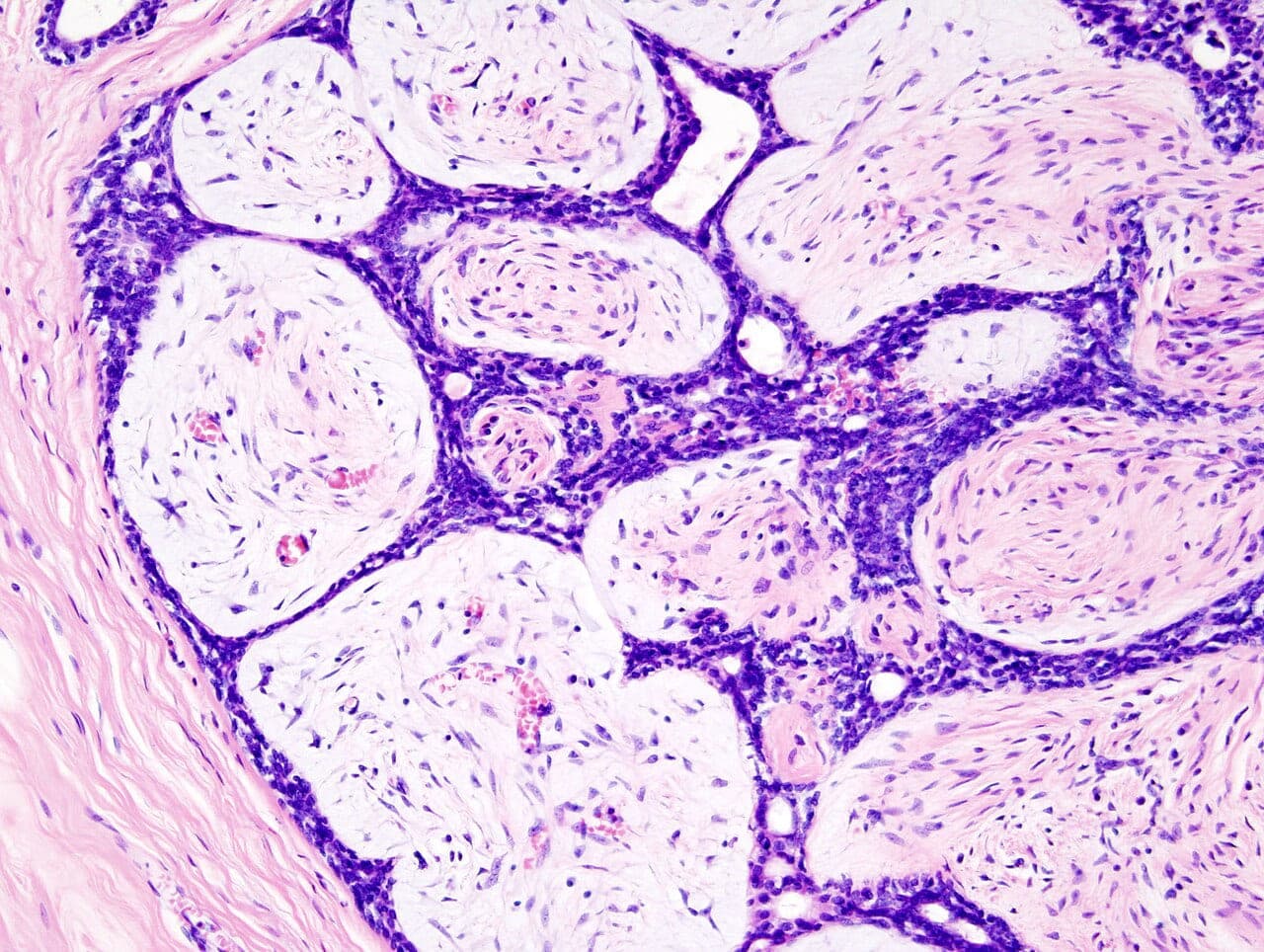 Microscopisch beeld van een borstfibroadenoom na een core needle biopsy, gekleurd met hematoxyline en eosine.