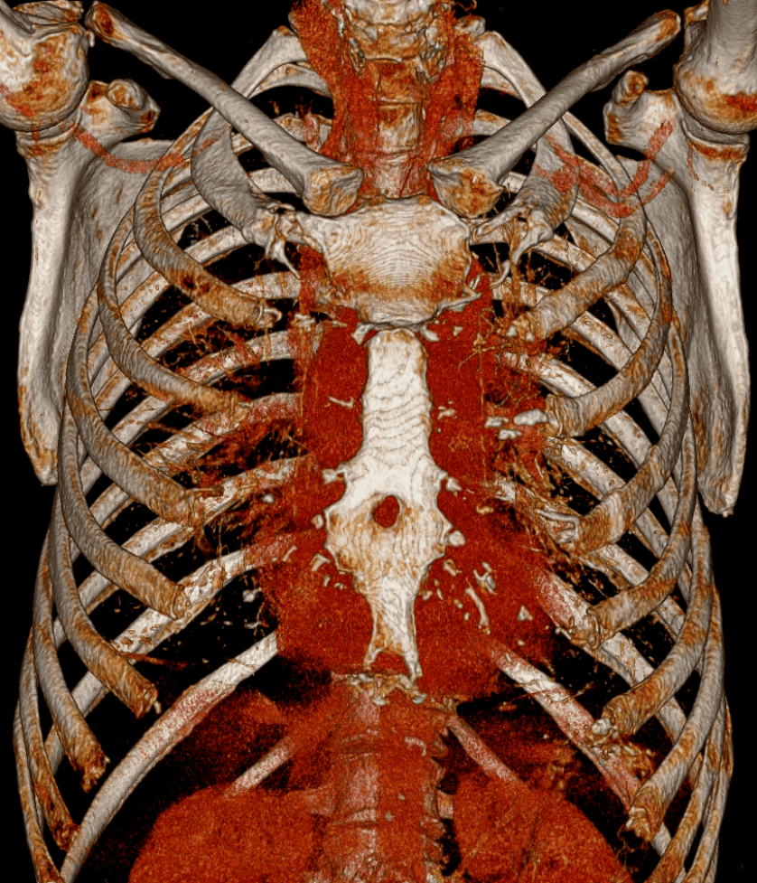 3D-CT-reconstructie van de borstkas waarop een sternaal foramen zichtbaar is als een ronde opening in het onderste deel van het borstbeen.