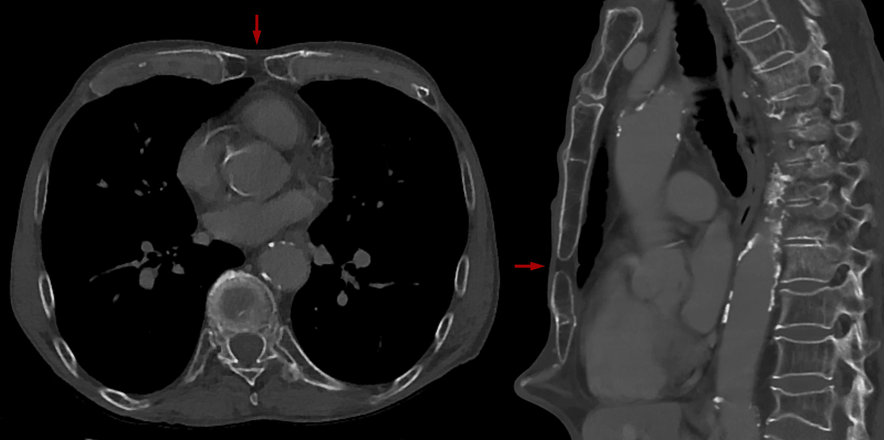 Axiale en sagittale CT-beelden van de borstkas waarop een sternaal foramen zichtbaar is; op de axiale opname is de kenmerkende vlinderdas- of strikvorm te zien.