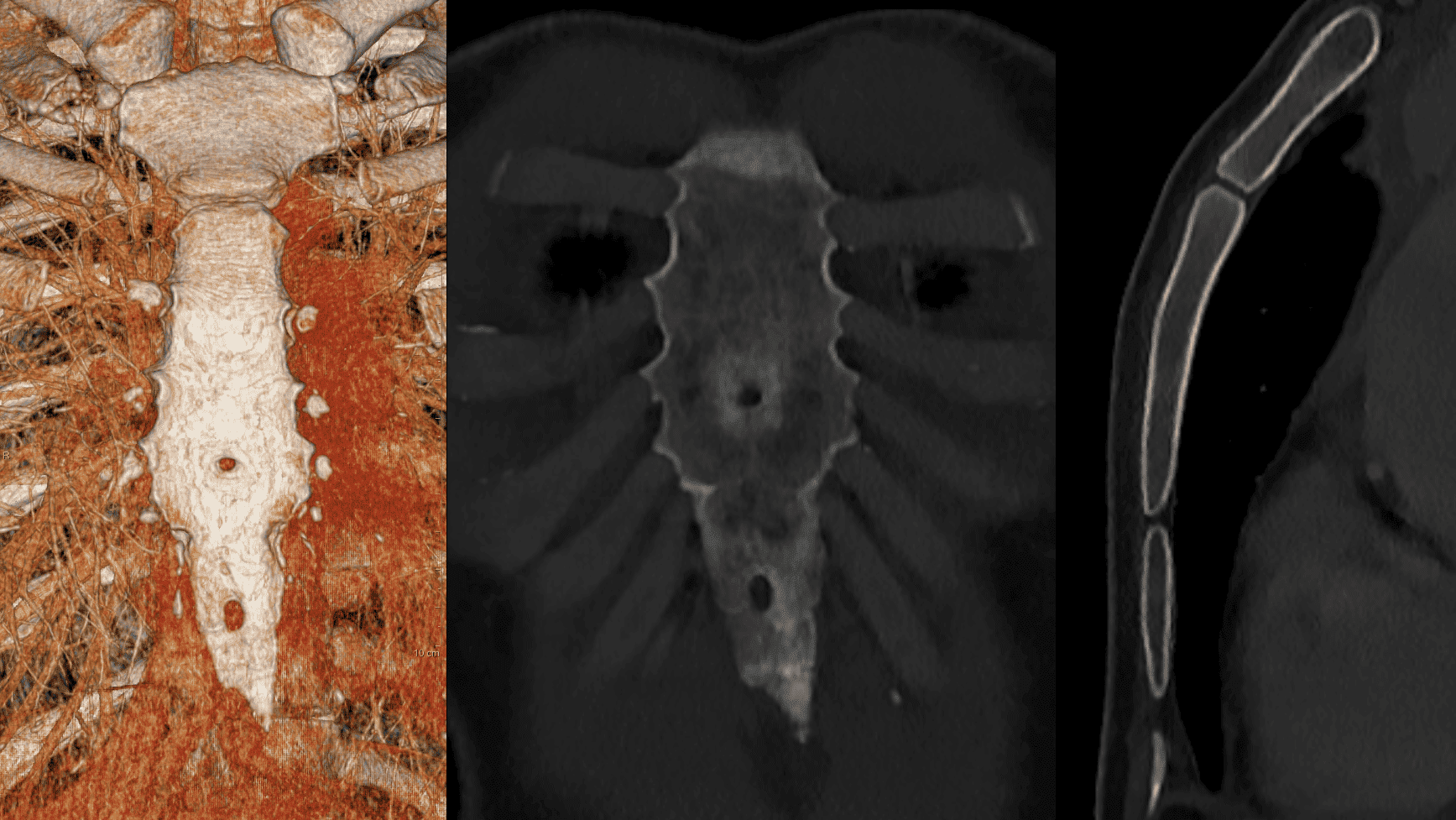 CT-beelden van het borstbeen met een zichtbaar sternaal foramen en xiphoïdaal foramen, openingen in het borstbeen en het zwaardvormig aanhangsel.